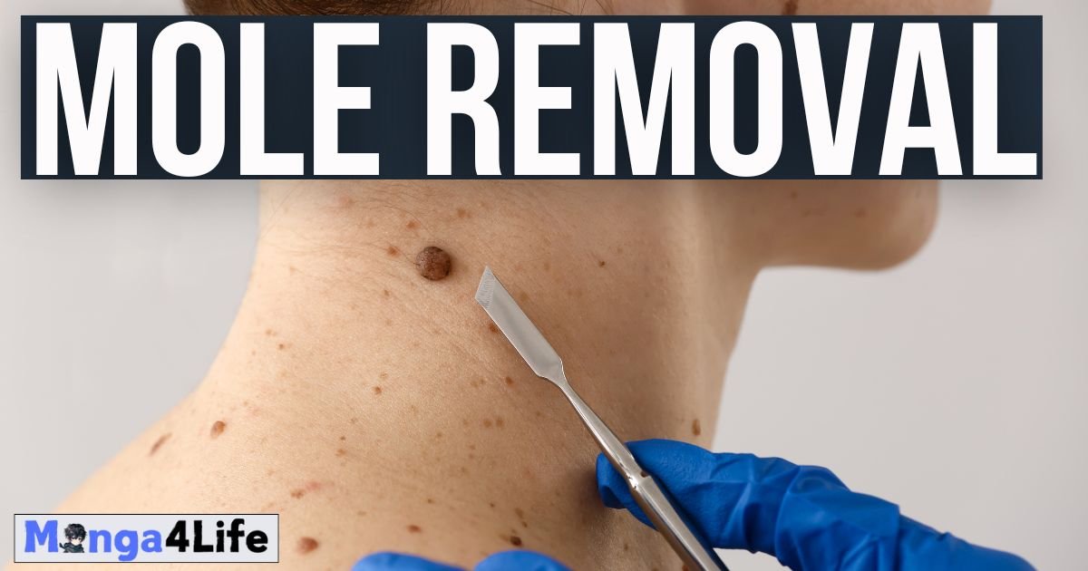 Safe and Effective Mole Removal Solutions in Sydney