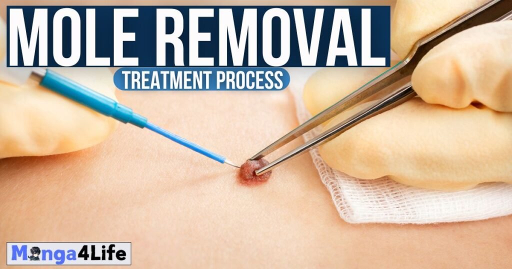 Mole Removal in Sydney: The Treatment Process